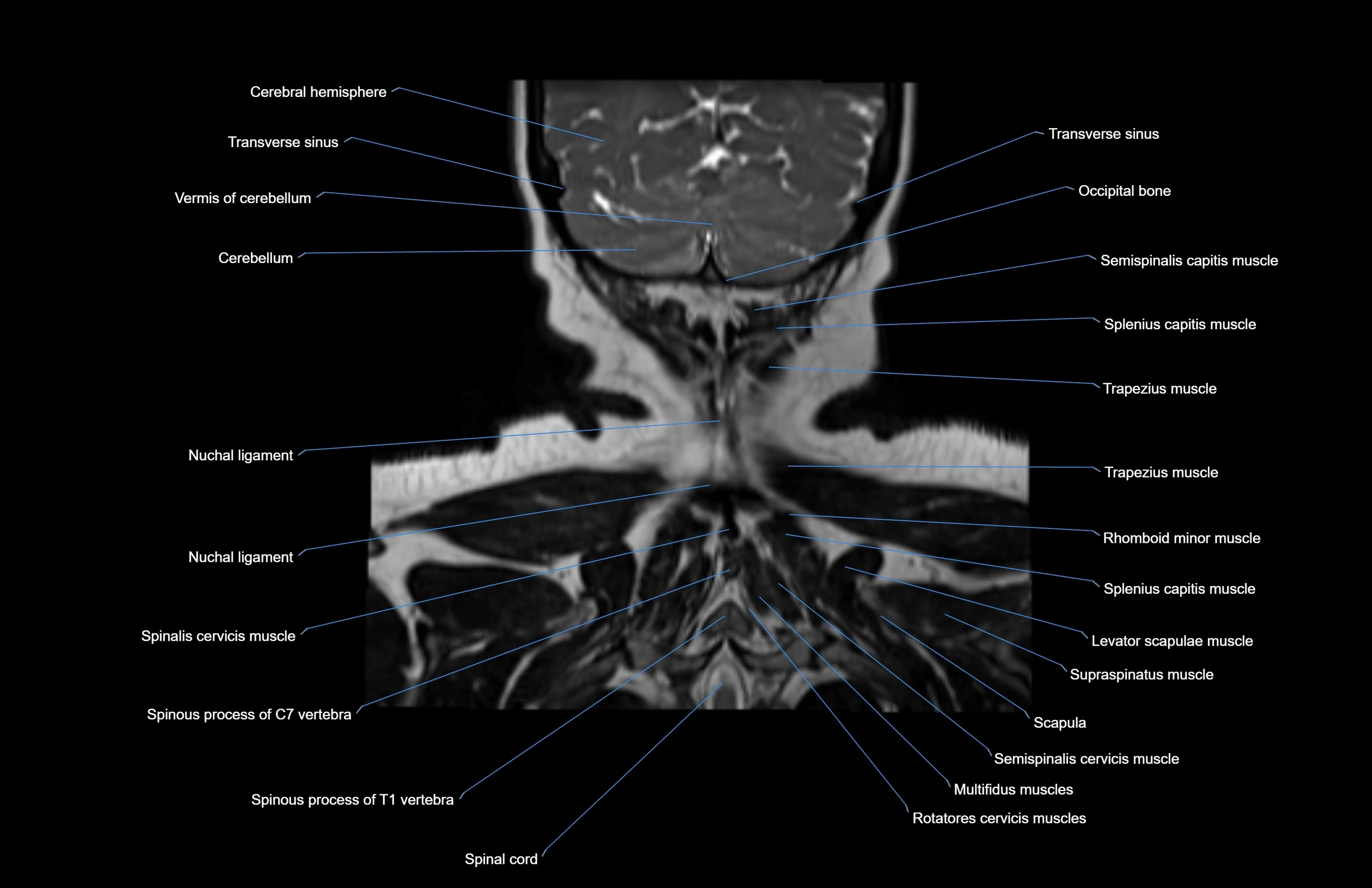 Neck coronal cross sectional MRI anatomy 3T MRI  image-img-00001-00006.webp